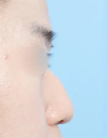  수술 전
