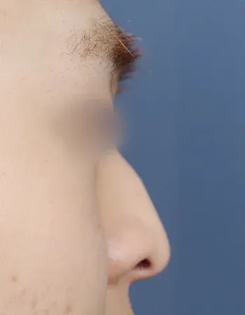  수술 전