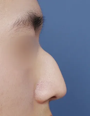  수술 전
