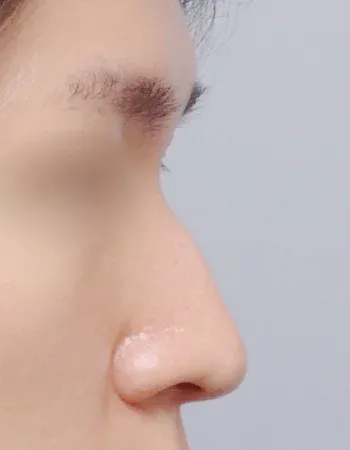  수술 전