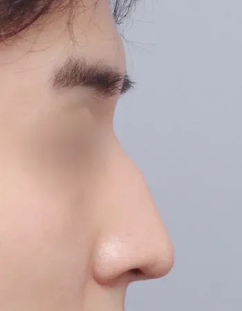  수술 전