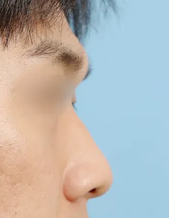  수술 전
