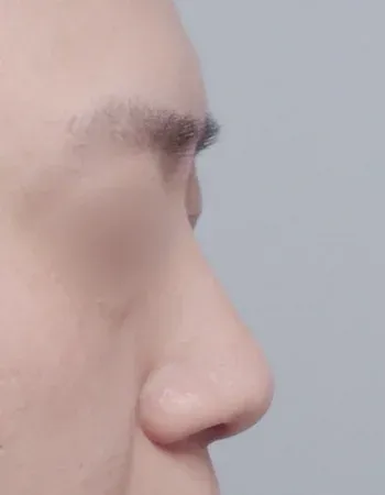 수술 전