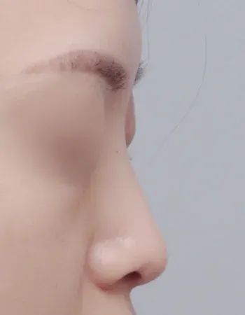  수술 전