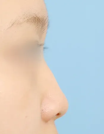  수술 전