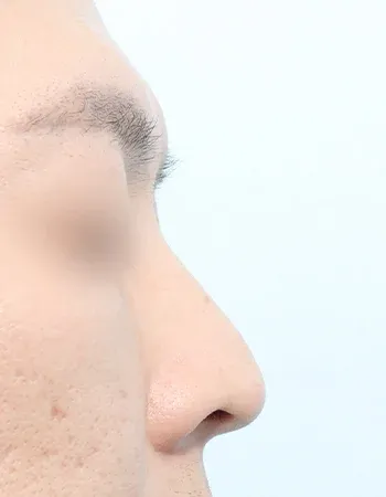  수술 전