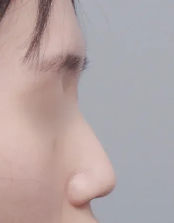  수술 전