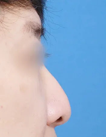  수술 전