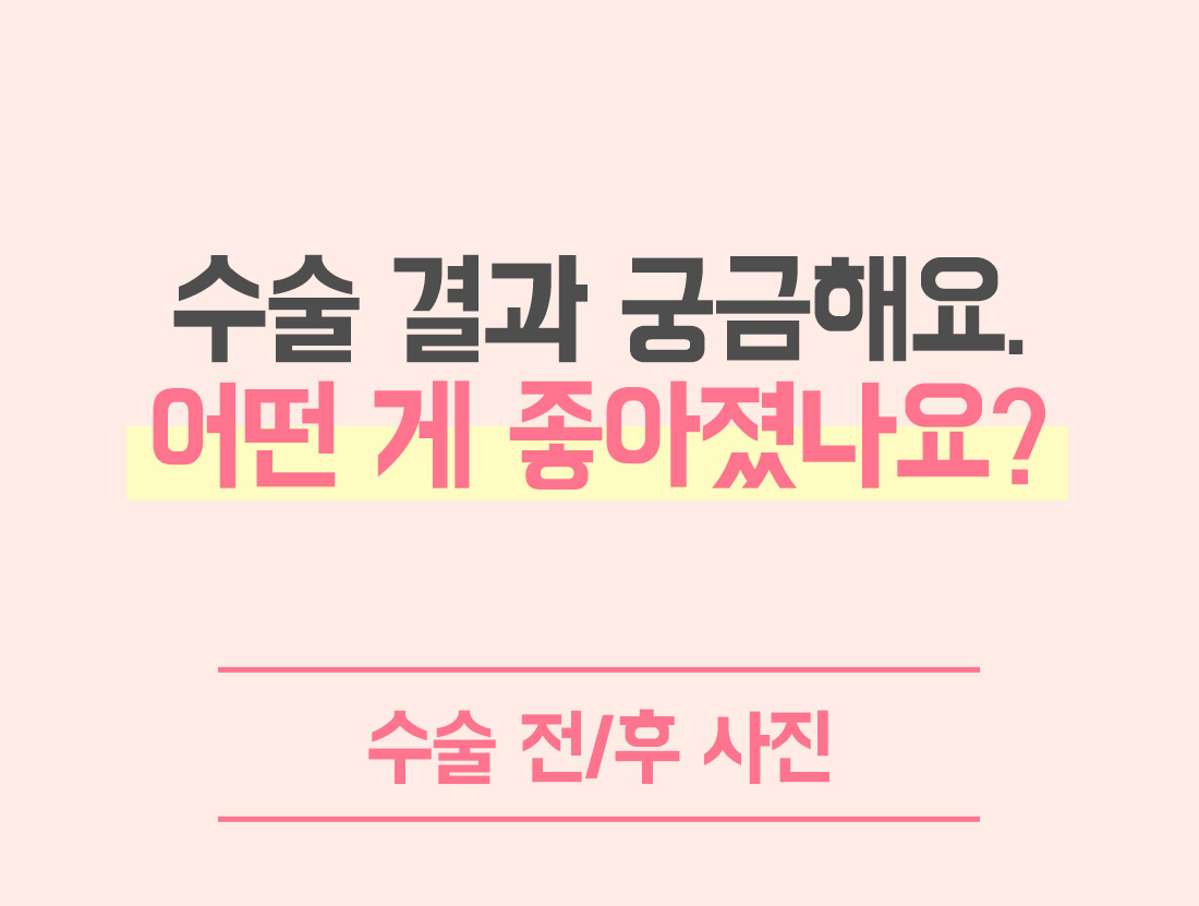 비중격만곡증 수술 전후사진