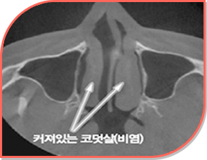 커져있는 코덧살(비염)