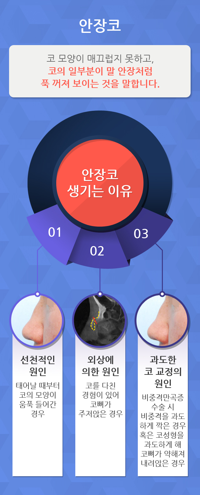 안장코 생기는 이유