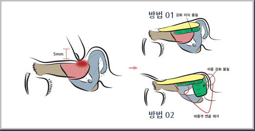 심하지 않은 안장코