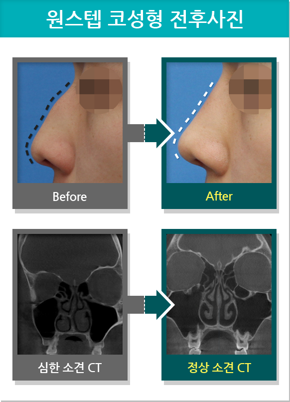 원스텝 코성형 전후사진