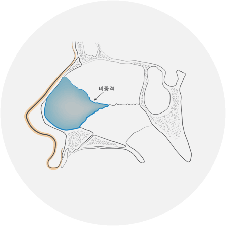 매부리코