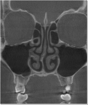 코재수술 CT 전후사진