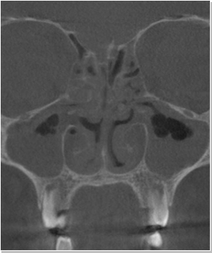 코재수술 CT 전후사진
