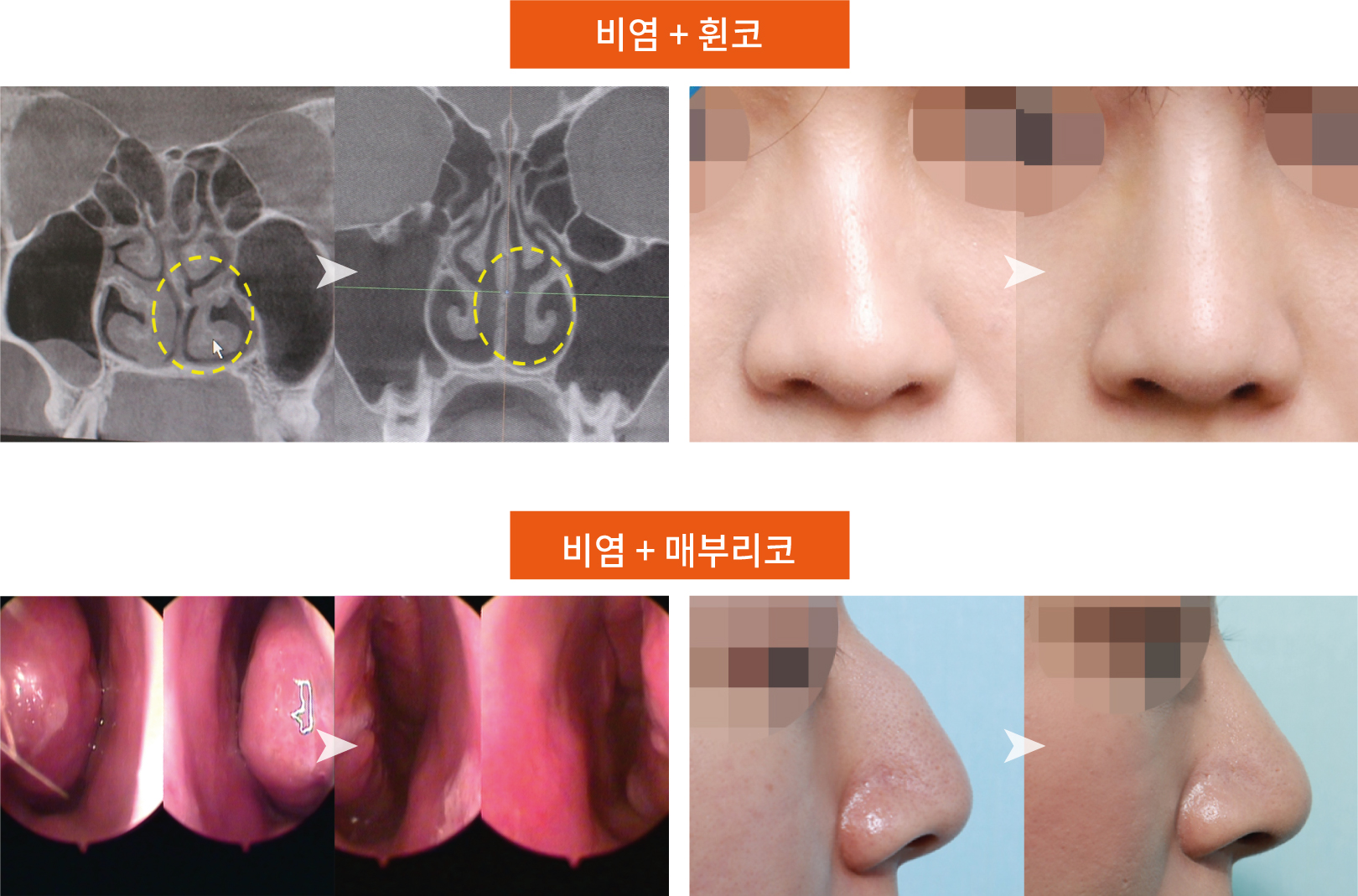 비염수술  CT 전후 사진