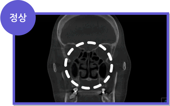 비염 CT 정상 소견