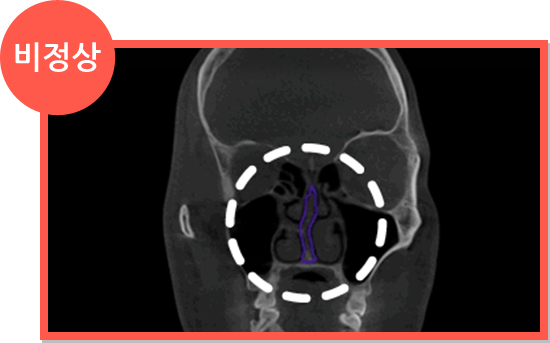 비염 CT 비정상 소견