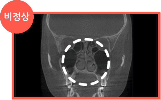 비염 CT 비정상 소견