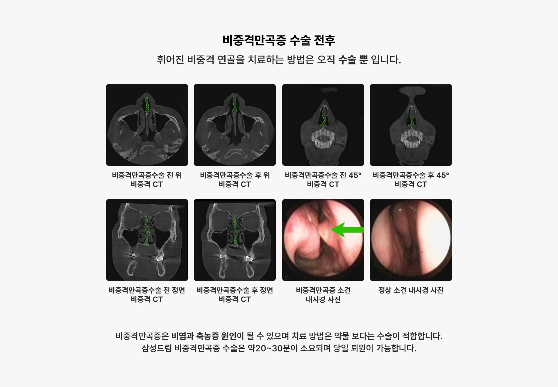 비중격만곡증 수술전후