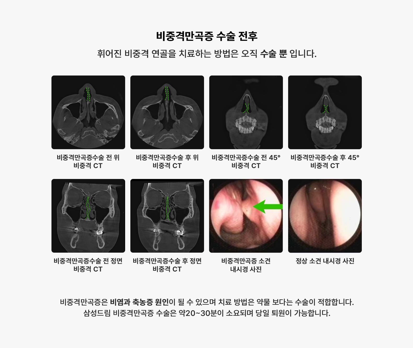 비중격만곡증 수술전후