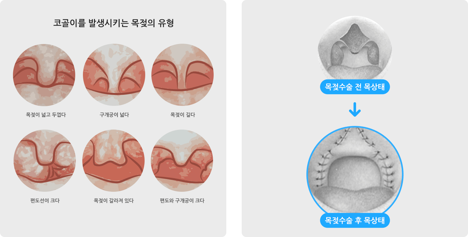 코골이를 발생시키는 목젖의 유형 사진