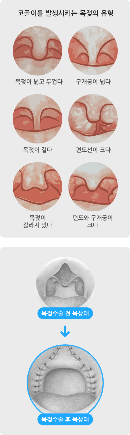 코골이를 발생시키는 목젖의 유형 사진