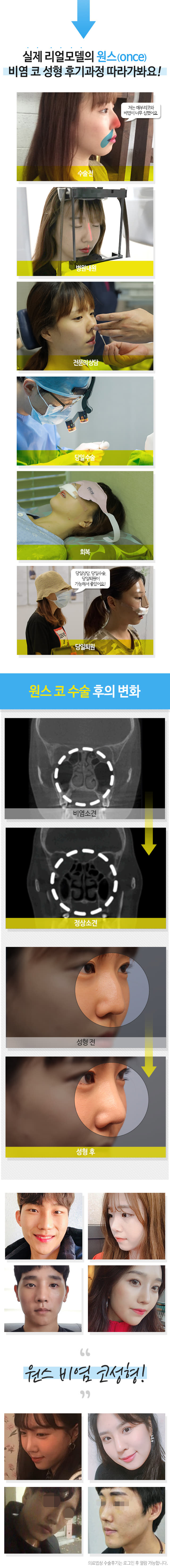 실제 리얼모델의 원스(ONCE) 비염 코 성형 후기과정 따라가봐요! 수술전 저는 매부리코와 비염이 너무 심했어요 병원내원 전문의상담 당일수술 회복 당일퇴원 당일상담, 당일수술, 당일퇴원이 가능해서 좋았어요! 원스 코 수술 후의 변화 비염소견 정상소견 성형 전 성형 후 원스 비염 코성형!