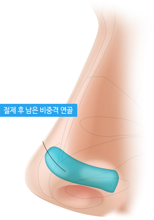 절체 후 남은 비중격 연골