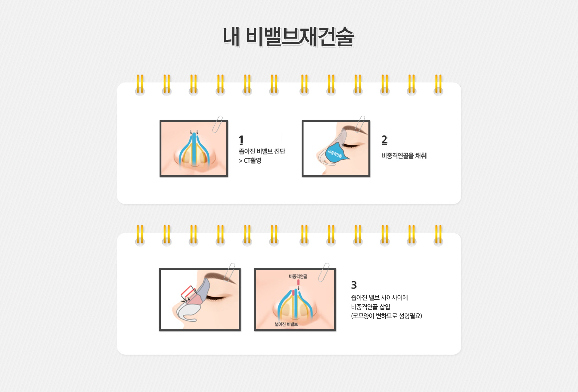 비밸브