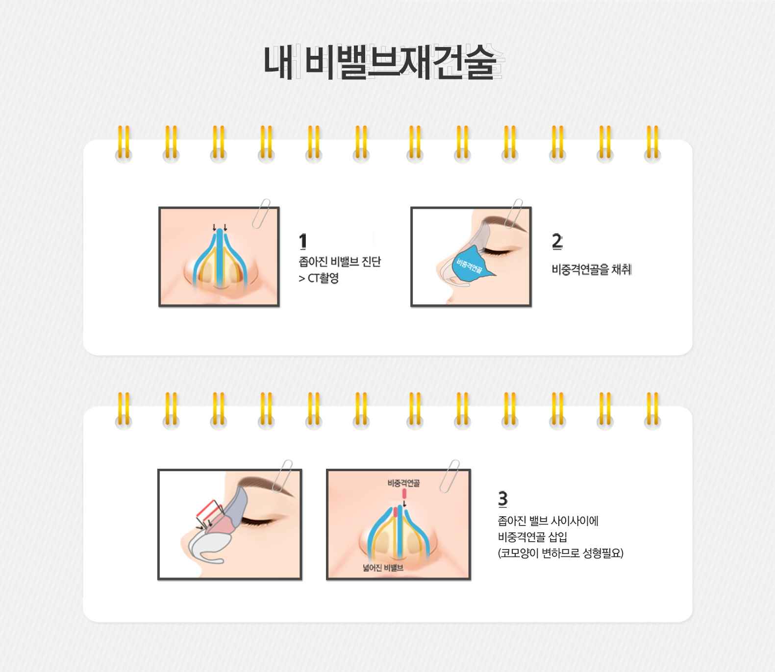 비밸브재건술