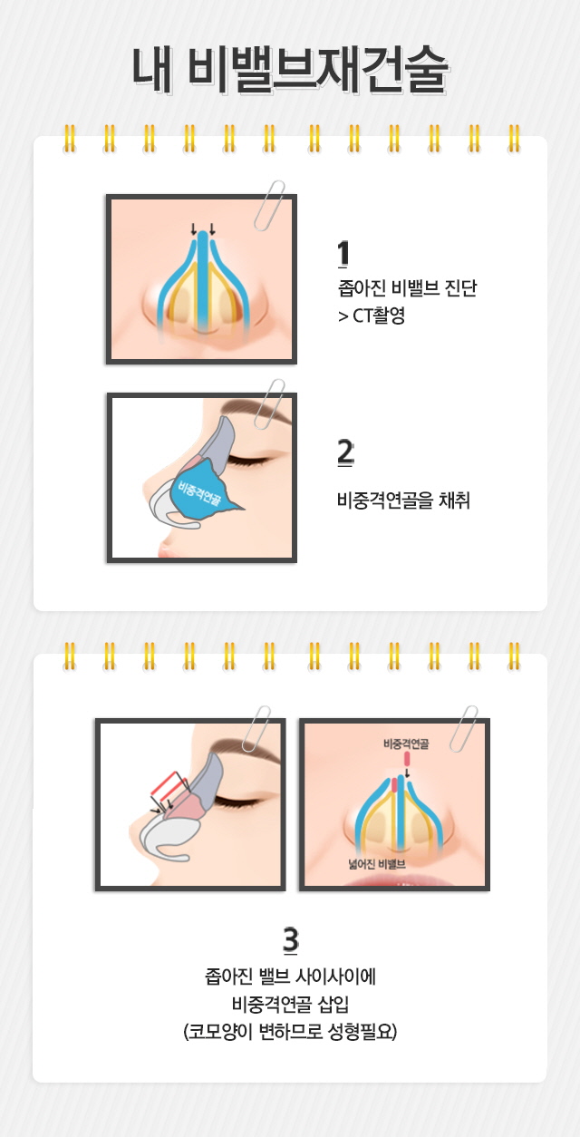 비밸브 재건 수술