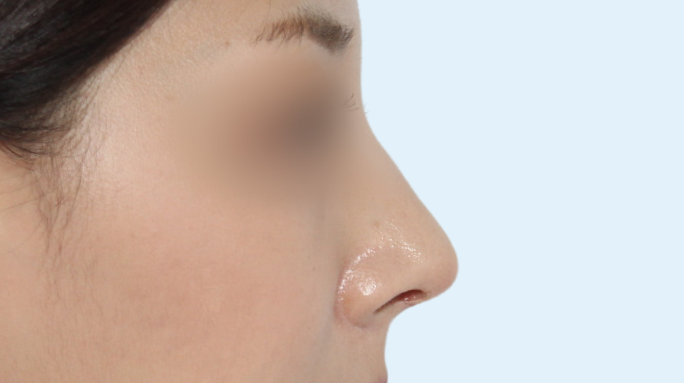 3D 보형물 코성형 수술 후 3개월 측면 비교 사진