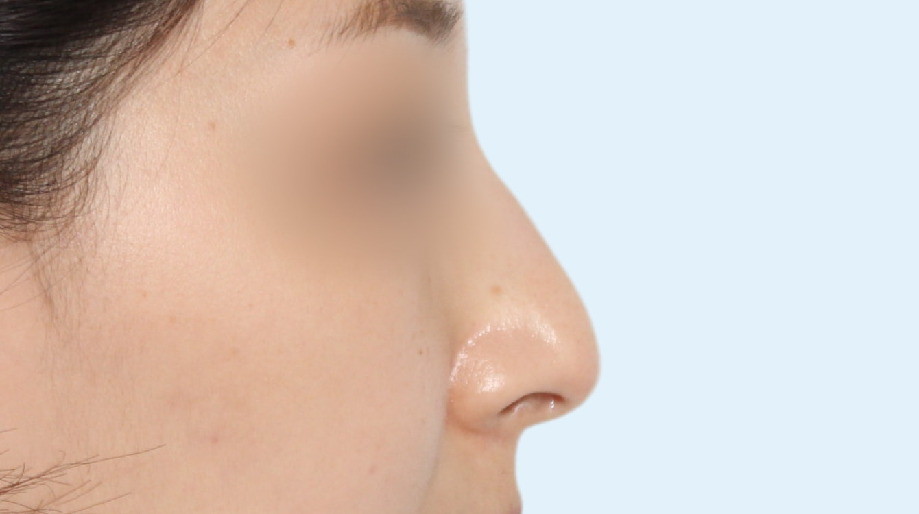 3D 보형물 코성형 수술 전 측면 비교 사진