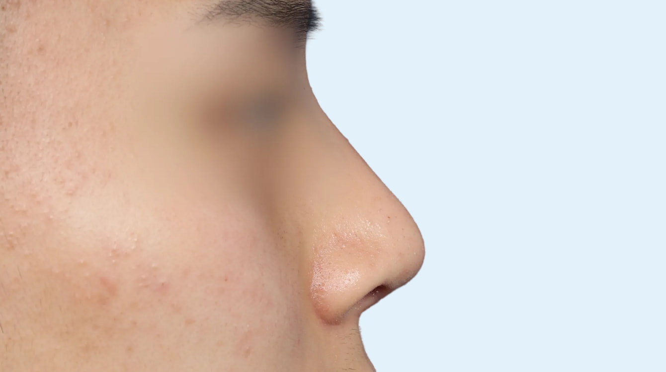 3D 보형물 코성형 전후 비교 2 수술 후 3개월 사진