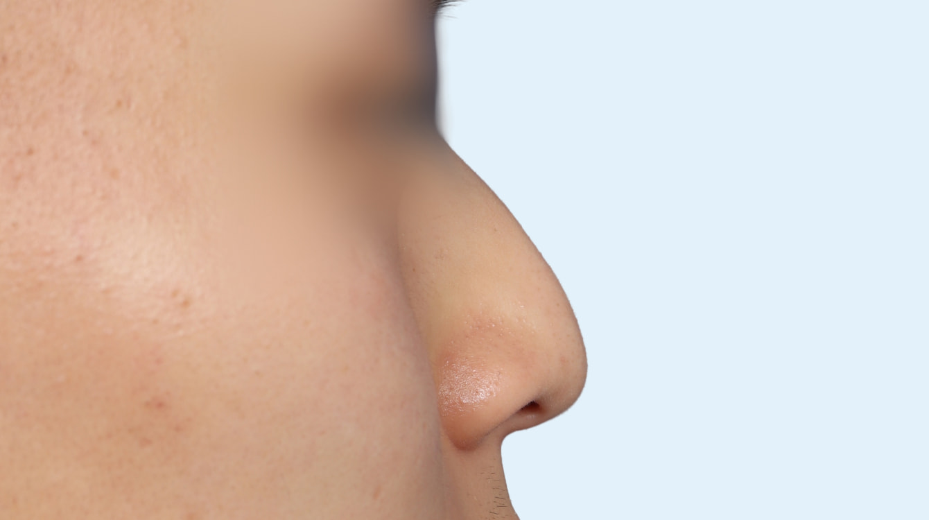 3D 보형물 코성형 전후 비교 2 수술 전 사진
