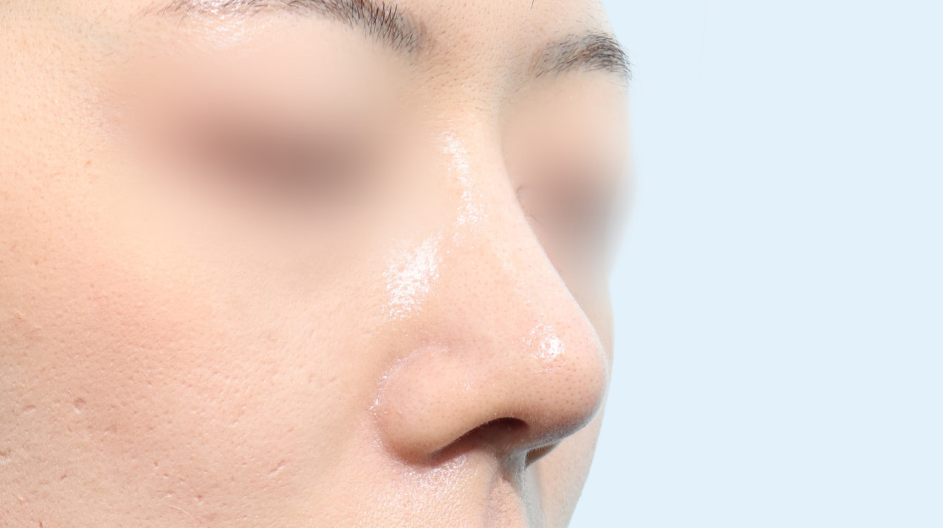 3D 보형물 코성형 전후 비교 3 수술 후 3개월 사진
