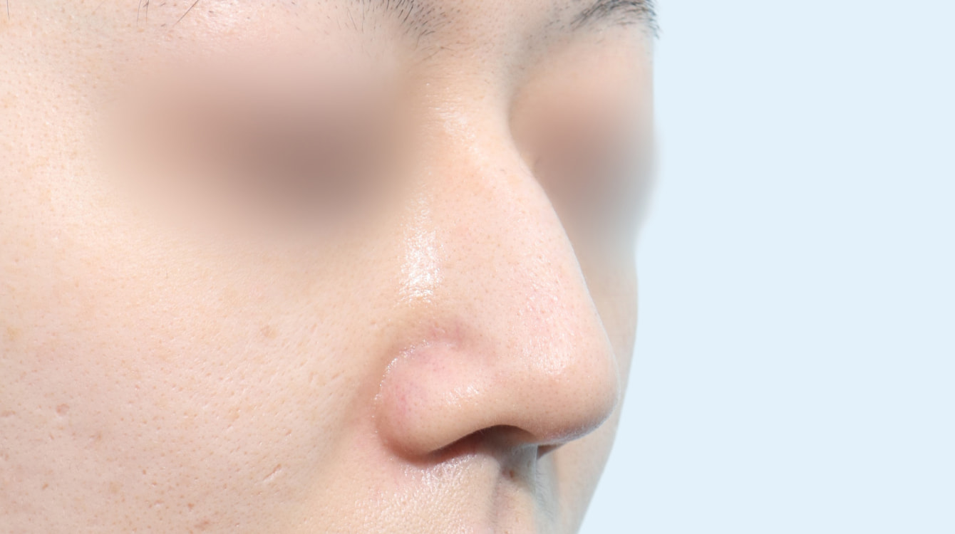 3D 보형물 코성형 전후 비교 3 수술 전 사진