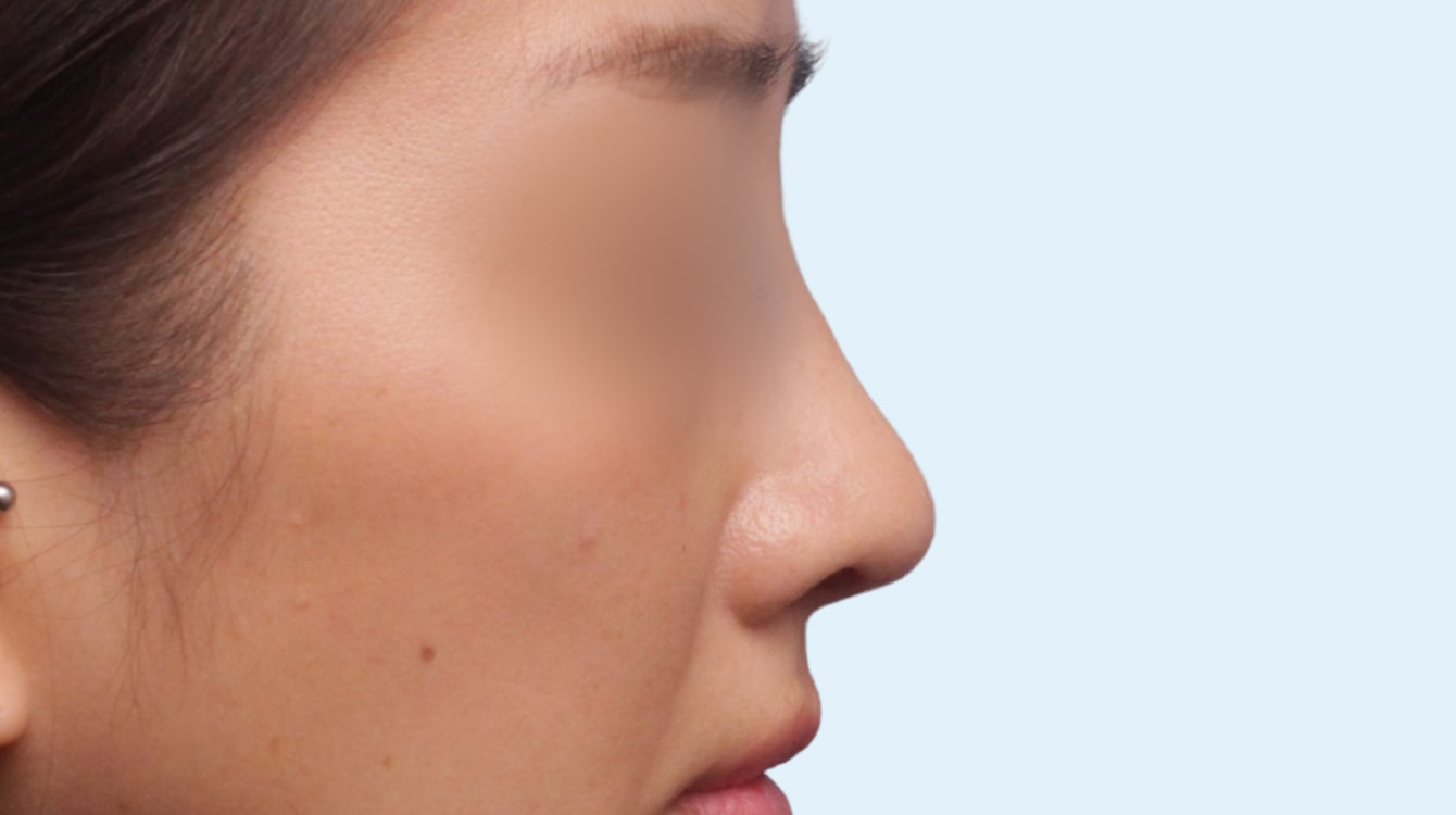 무보형 코성형 수술 후 3개월 측면 비교 사진