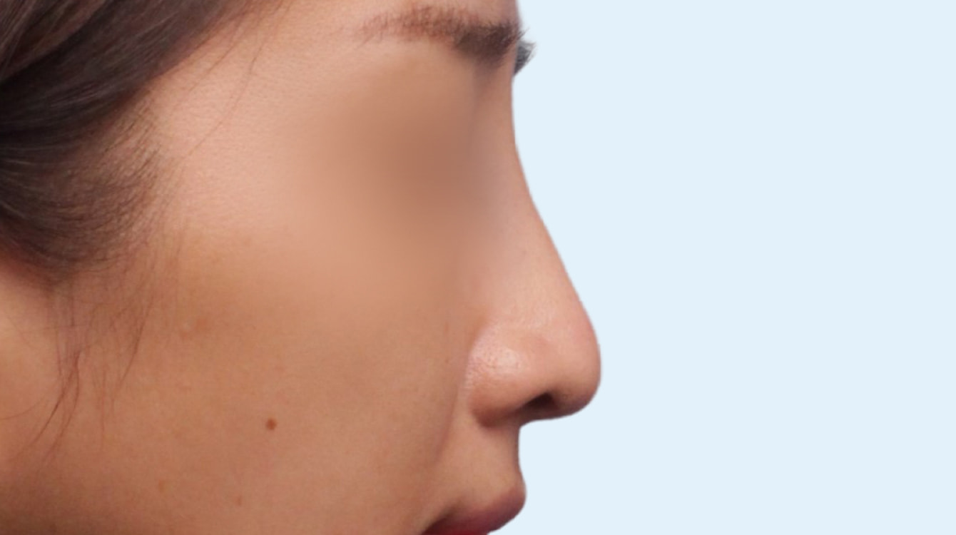 무보형 코성형 수술 전 측면 비교 사진