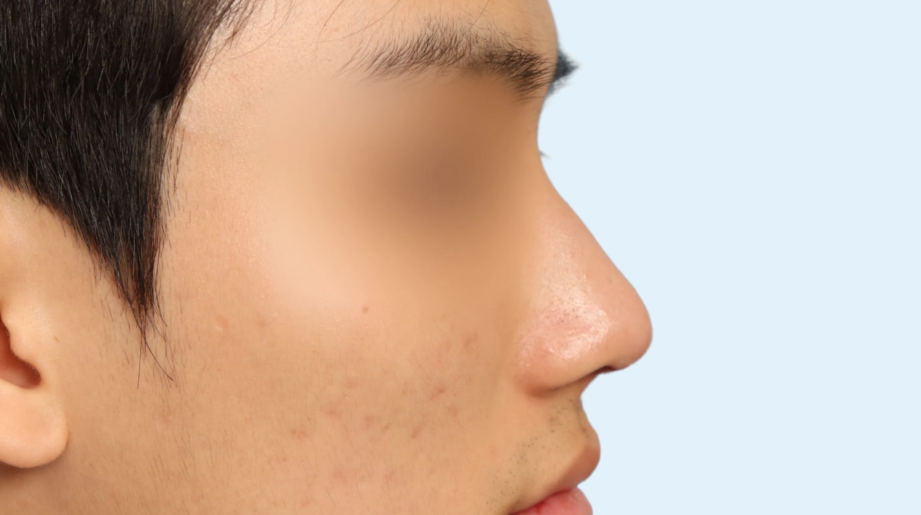 무보형 코성형 전후 비교 3 수술 후 3개월 사진
