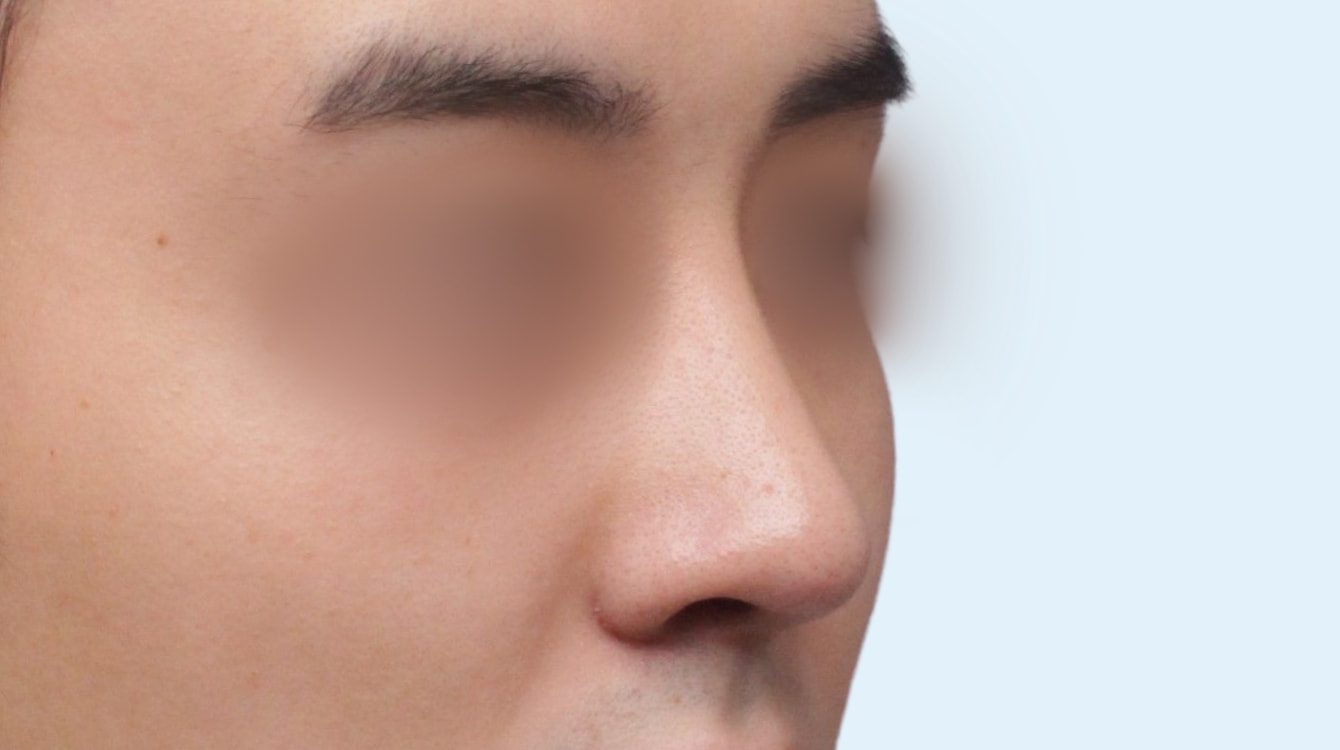 남자 코성형 수술 후 3개월 정면 비교 사진