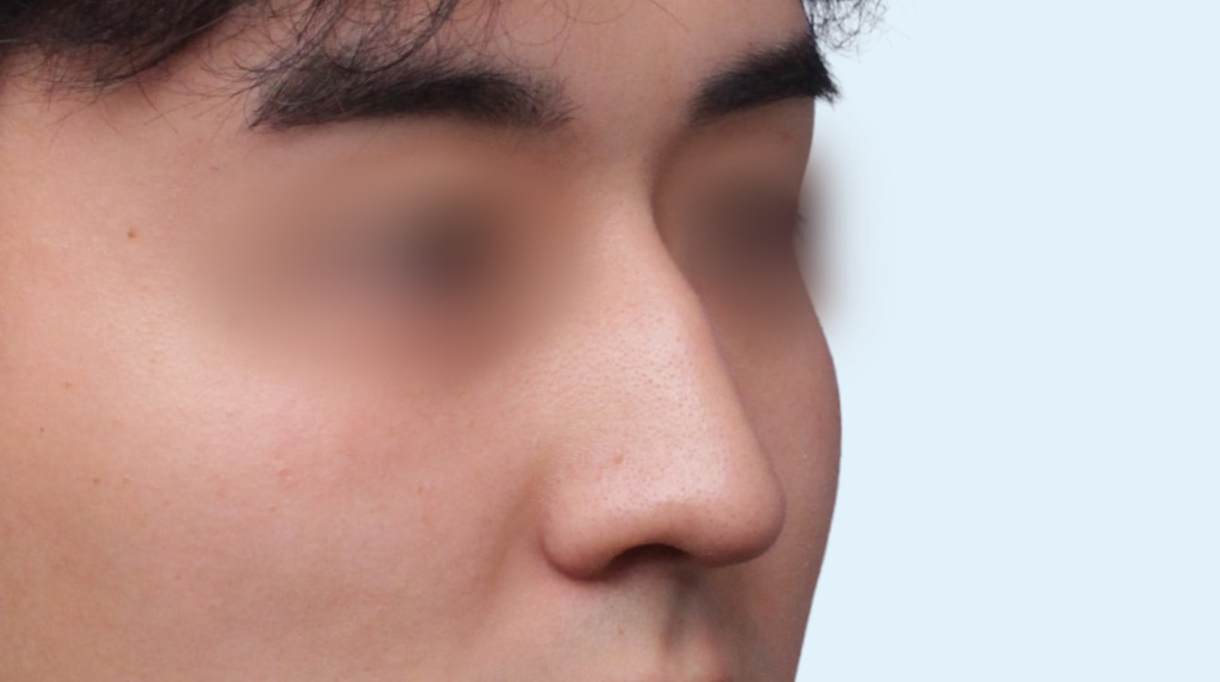 남자 코성형 수술 전 정면 비교 사진
