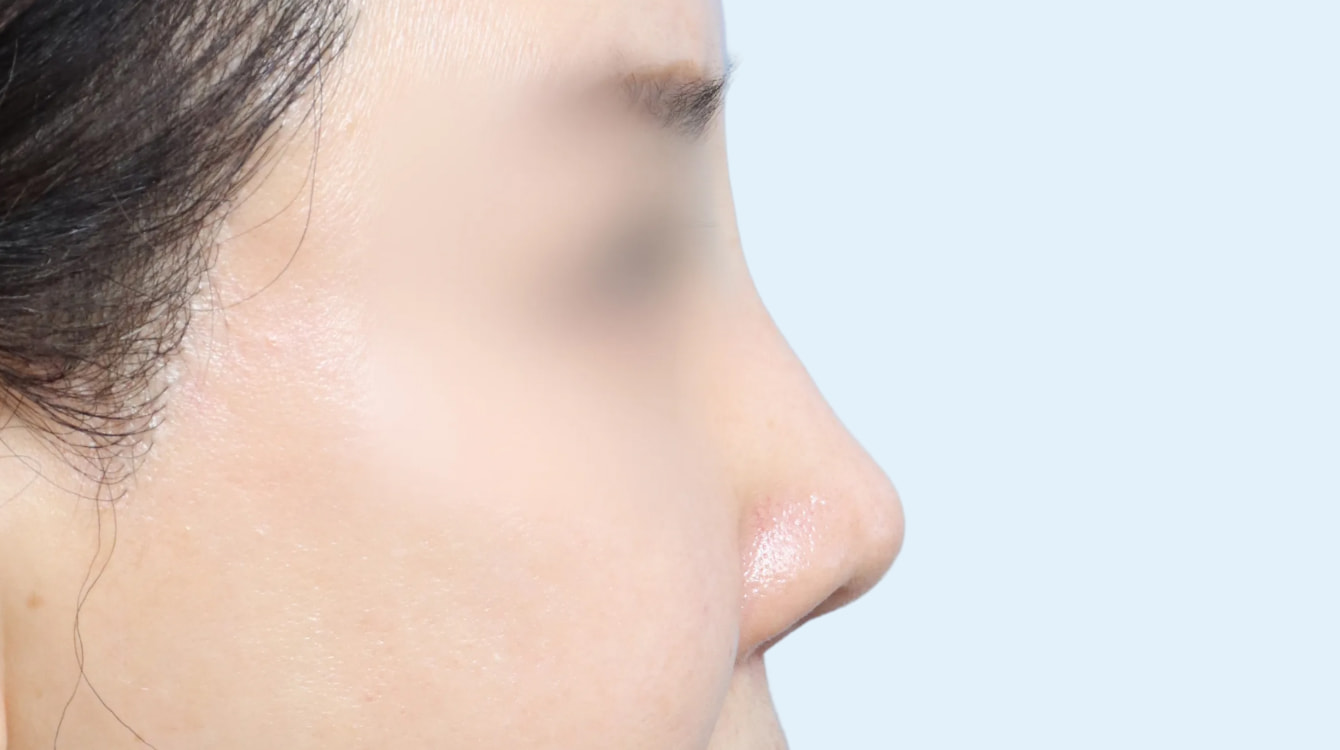 코 재수술 후 3개월 측면 비교 사진