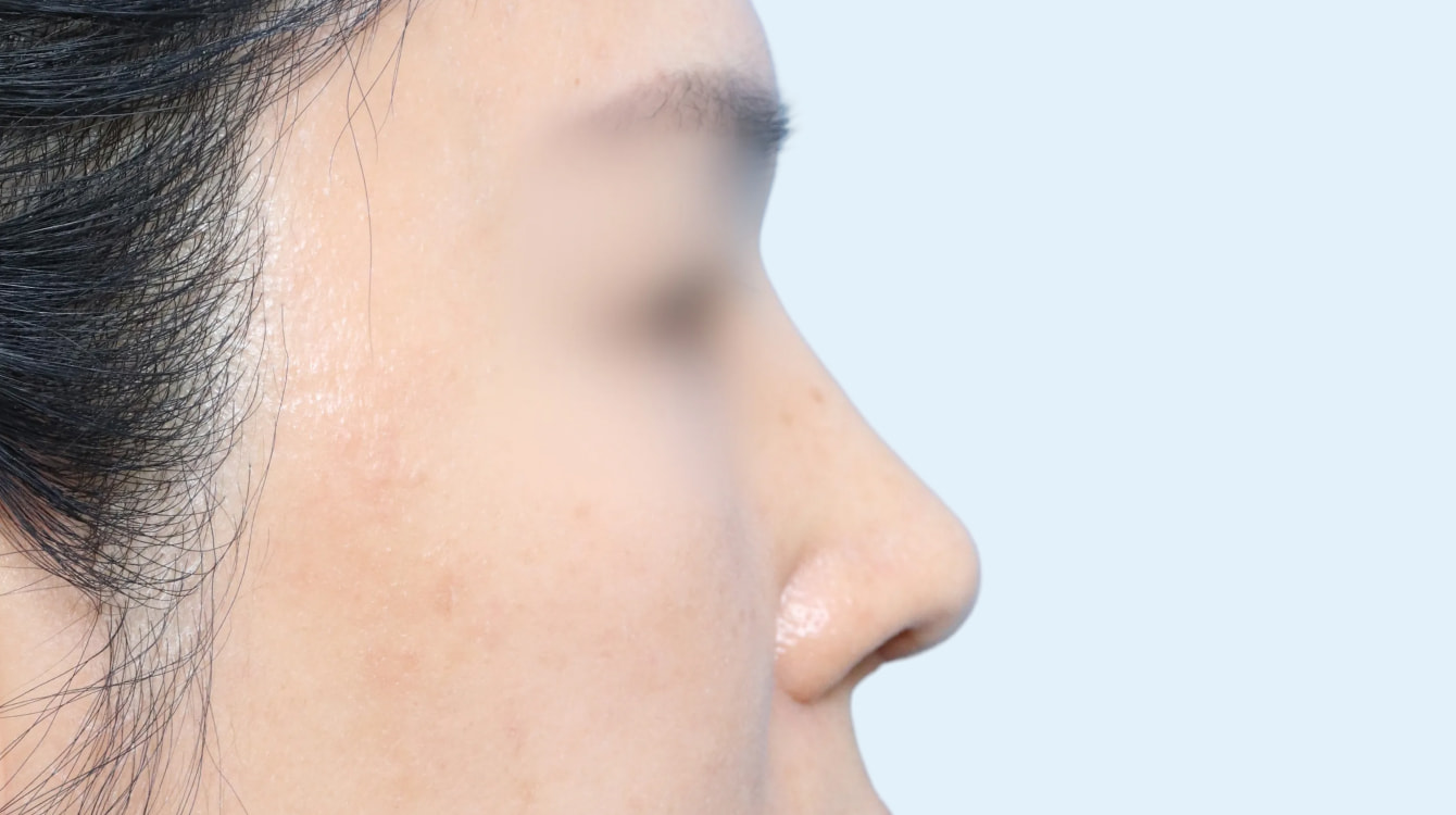 코 재수술 전후 비교 2 수술 후 3개월 사진