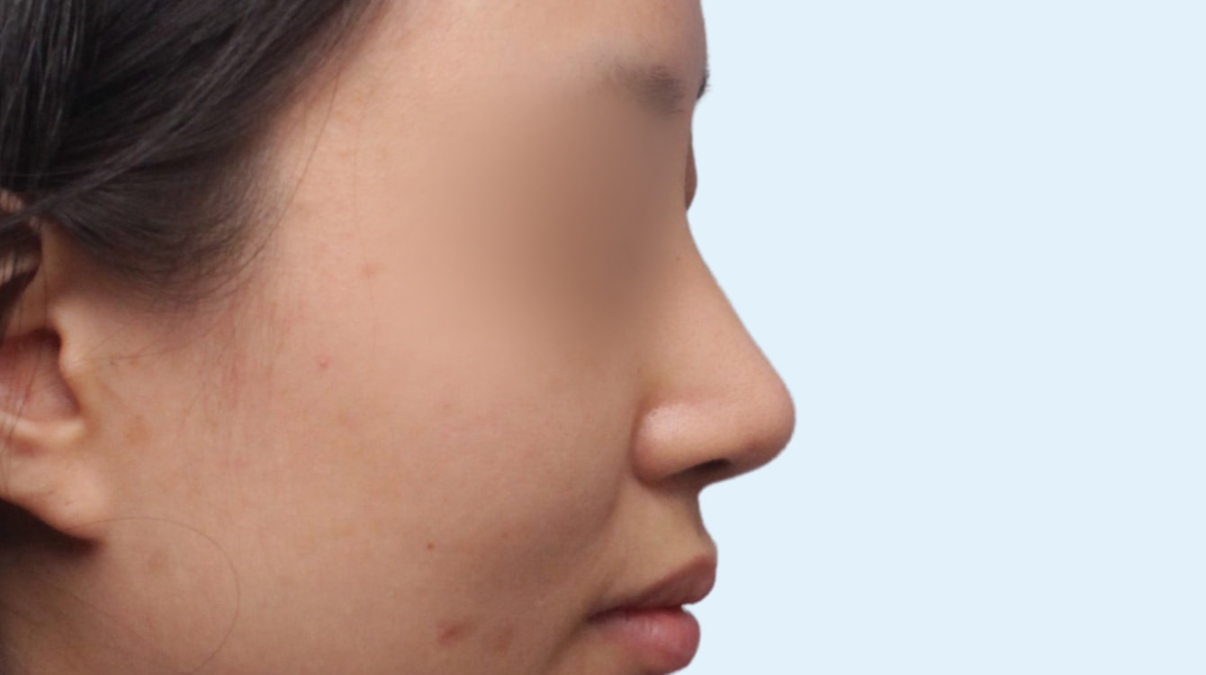 유형별 코성형 수술 후 3개월 측면 비교 사진