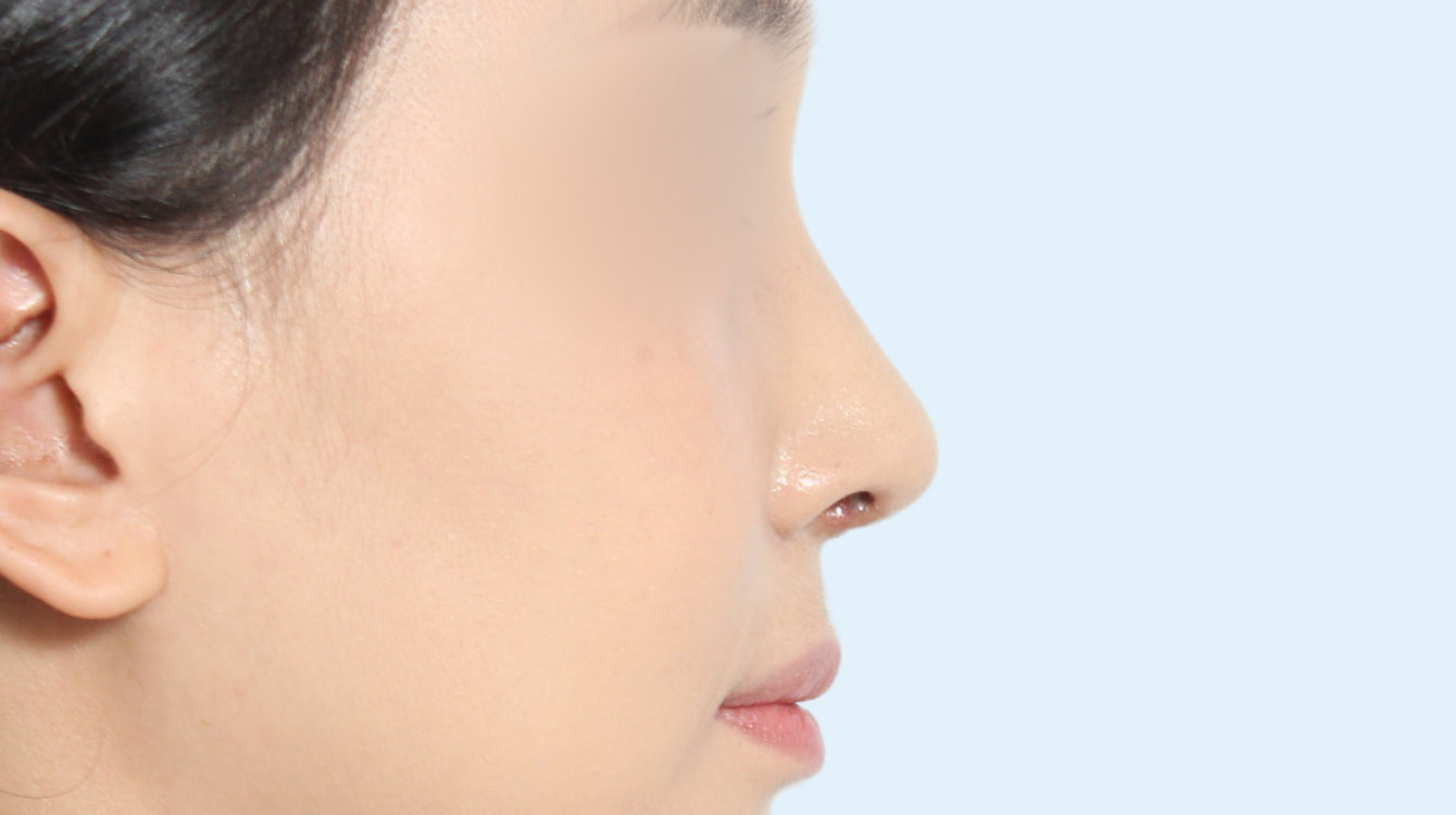 낮은코 성형 전후 비교 2 수술 후 3개월 사진
