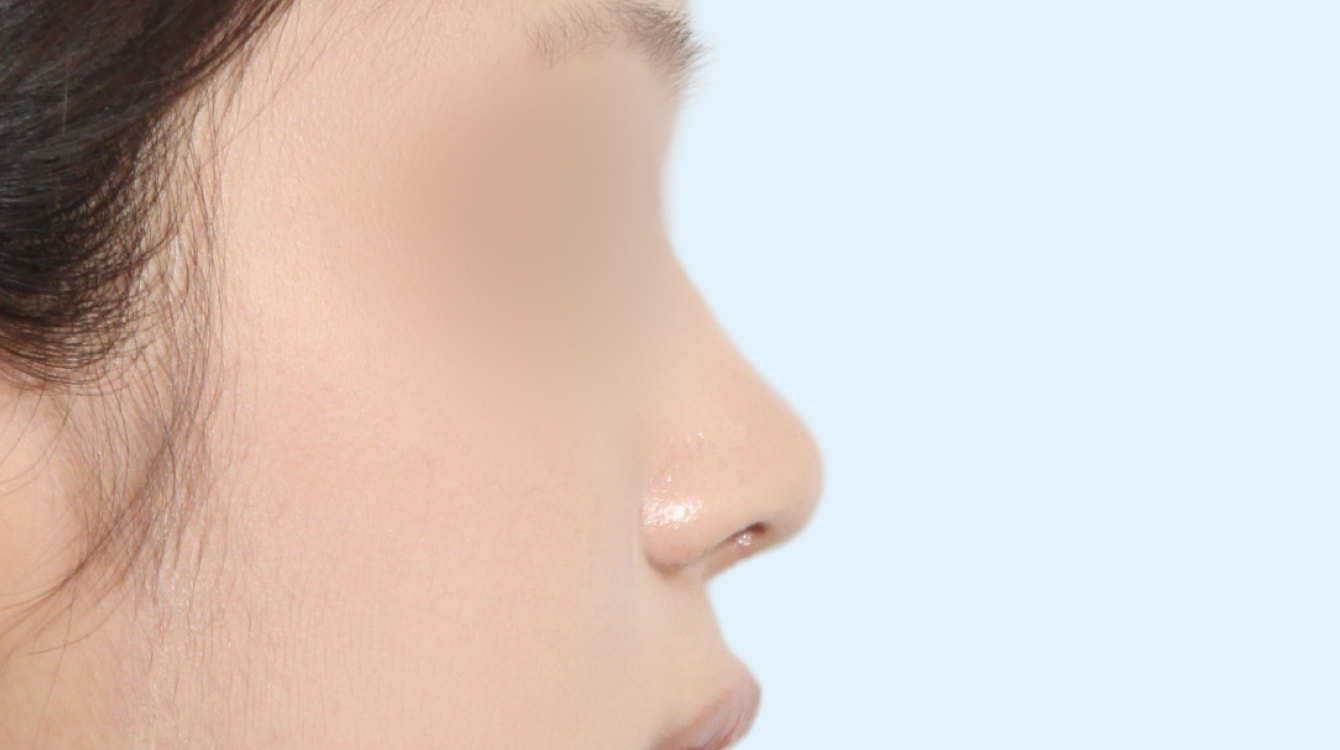 화살코 성형 전후 비교 1 수술 후 3개월 사진