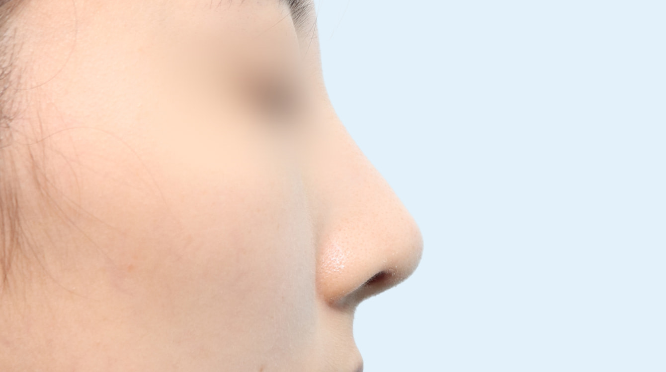 처진 코끝 성형 전후 비교 3 수술 후 3개월 사진